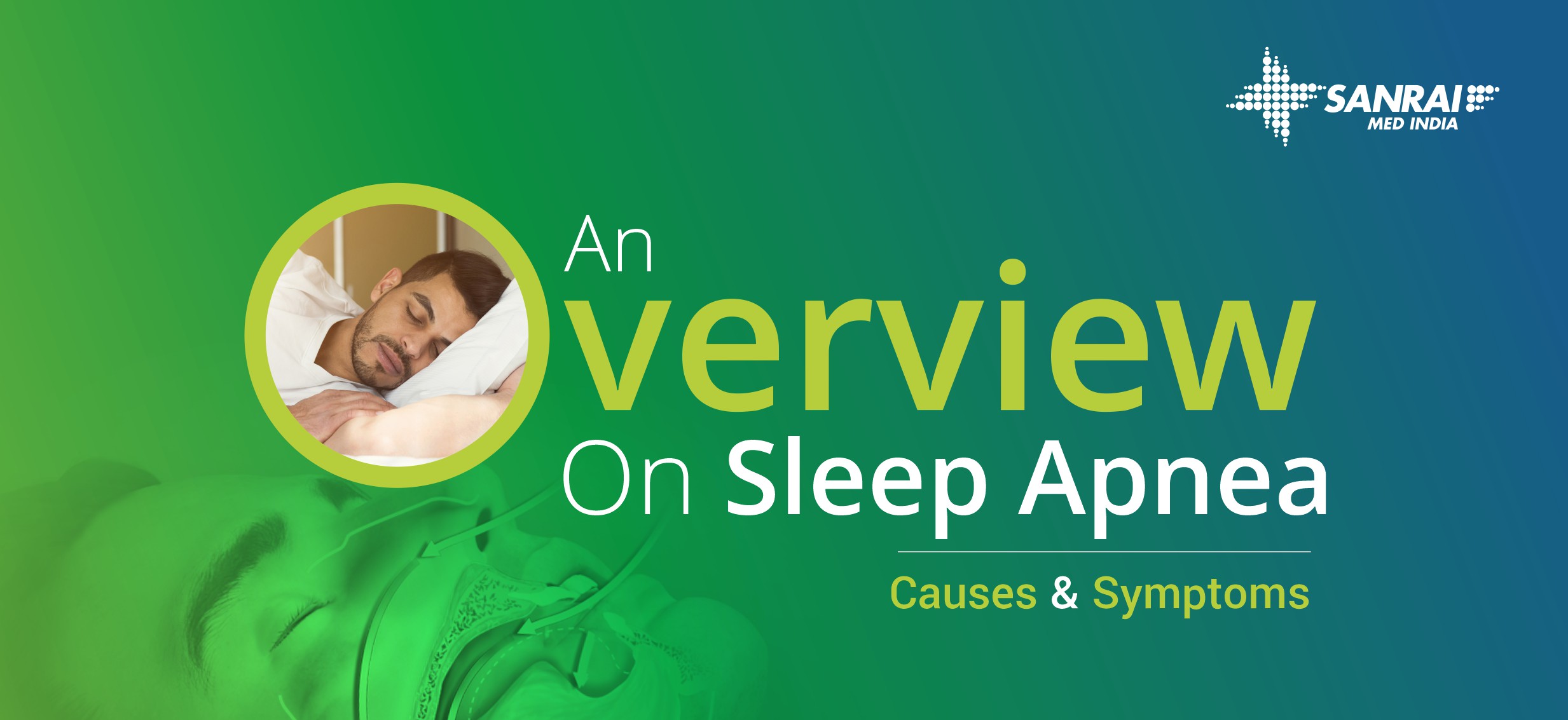 An Overview On Sleep Apnea - Causes & Symptoms